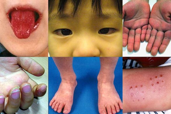 Covid-19 Kawasaki disease